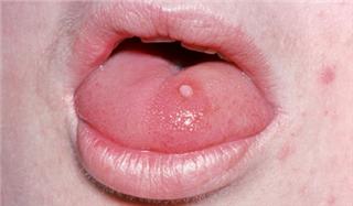 Papilloma virus infezione, I sintomi del papilloma virus,